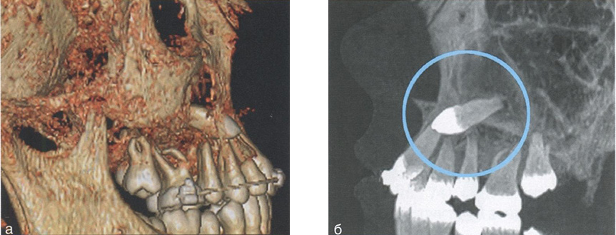 Оценка положения ретинированного зуба