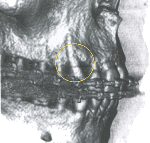 Дегисценция костной ткани в области зуба