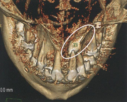 Мультиспиральная компьютерная томограмма. Аномалия прорезывания зуба