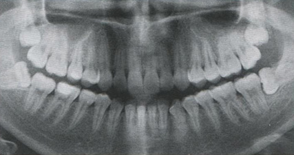 Ортопантомограмма. Аномалия положения зубов 1.8, 2.8, 3.8, 4