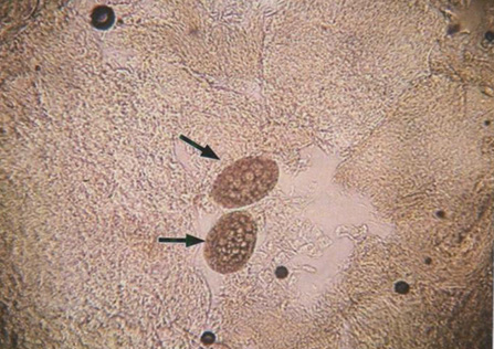 Яйца чесоточного клеща (стрелки) при исследовании нативного препарата