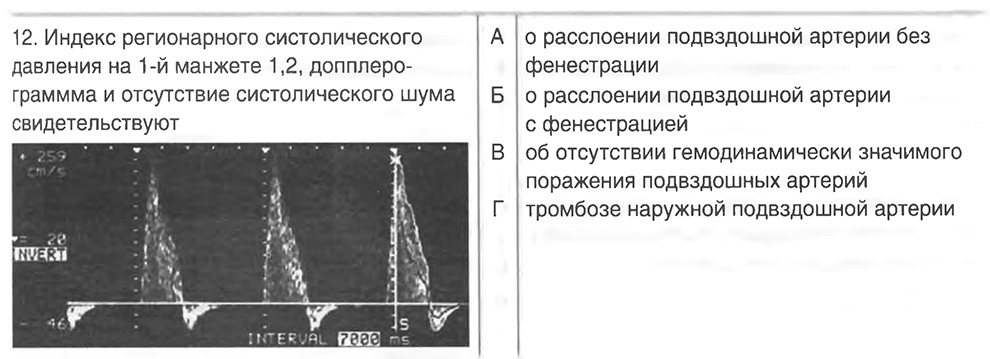 Расслаивающая аневризма аорты