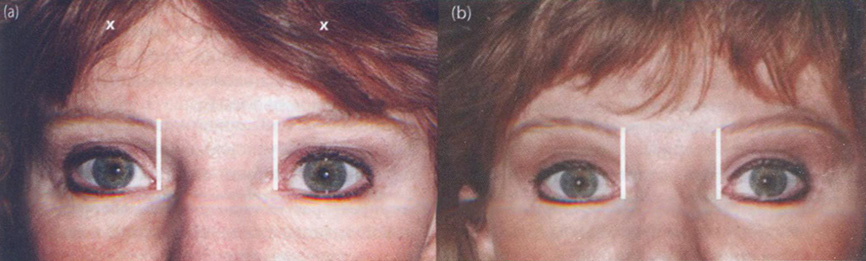 Пациентка с «подвижной» областью межбровья до введения ботулотоксина