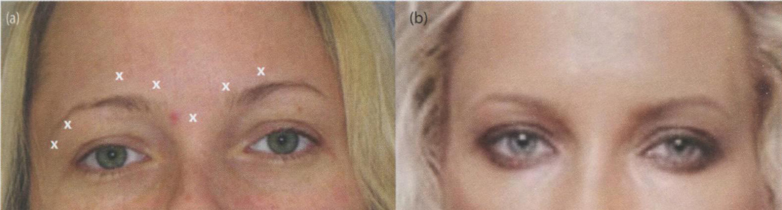  Асимметрия бровей до процедуры