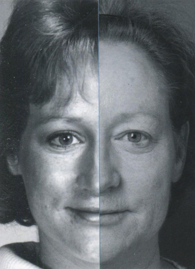 8.13. Сужение глазной щели после 30 лет.