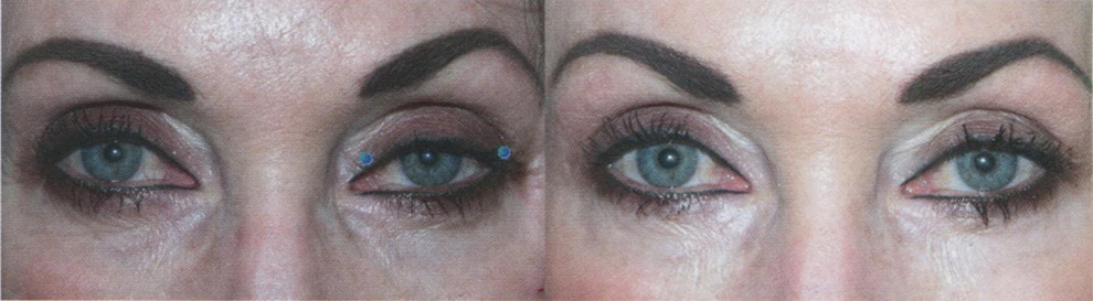 Точки субдермального введения ботулотоксина и результат в виде расширения глазной щели