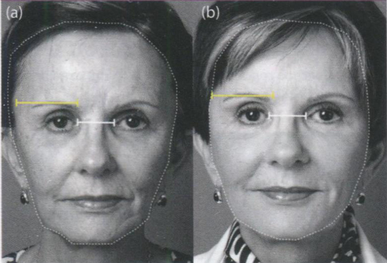  Пациентка до (а) и после бьютификации: фотографии демонстрируют уменьшение ширины висков до идеальных пропорций