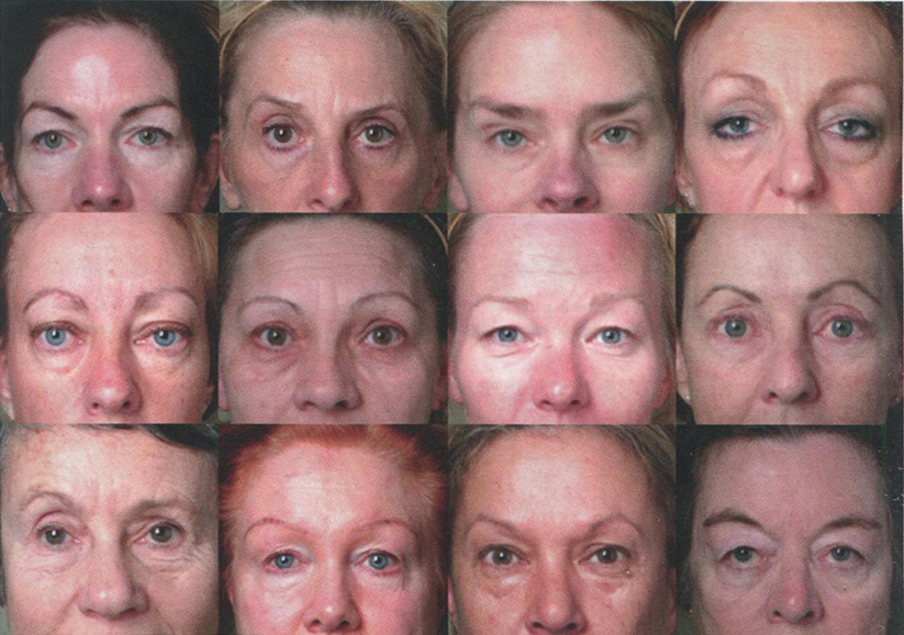 Приподнятые брови часто характерны для пожилого возраста