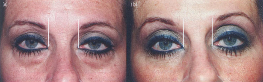 До введения ботулотоксина в область межбровья