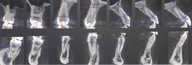  Кросс-секции зубов верхней и нижней челюсти справа на компьютерных томограммах в окне мультипланарной реконструкции