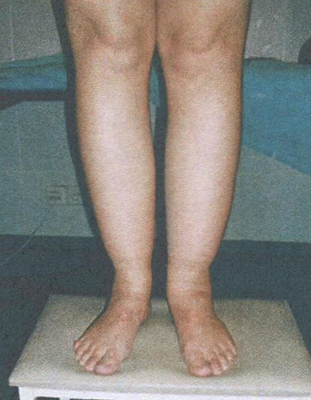 Идиопатические гипостатические отёки Идиопатические гипостатические отёки