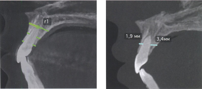 Оценка положения резцов на компьютерных томограммах с помощью линейных параметров