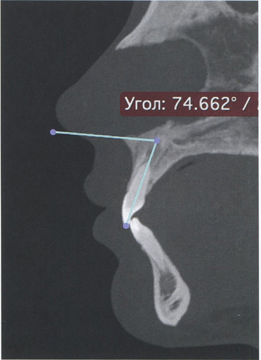 Оценка положения зуба 2.1 с помощью углового параметра на компьютерных томограммах в окне мультипланарной реконструкции