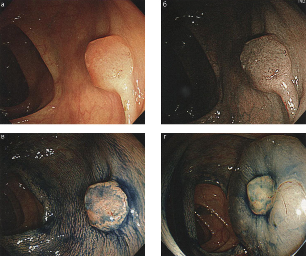  Признаки отсутствия лифтинга малигнизированного «сидячего» полипа