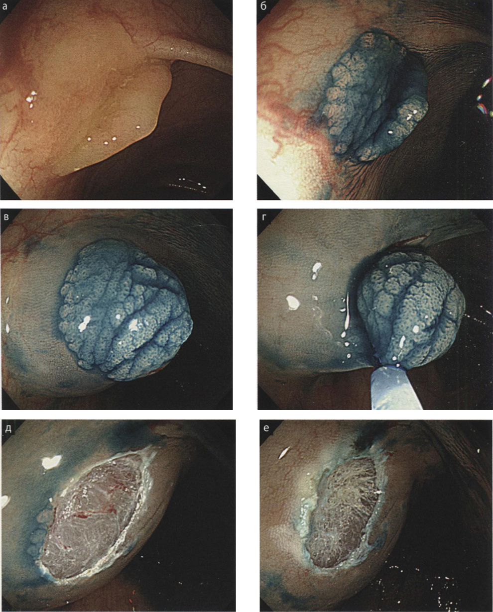 Полипэктомия «сидячей» зубчатой аденомы с использованием инъекций раствора
