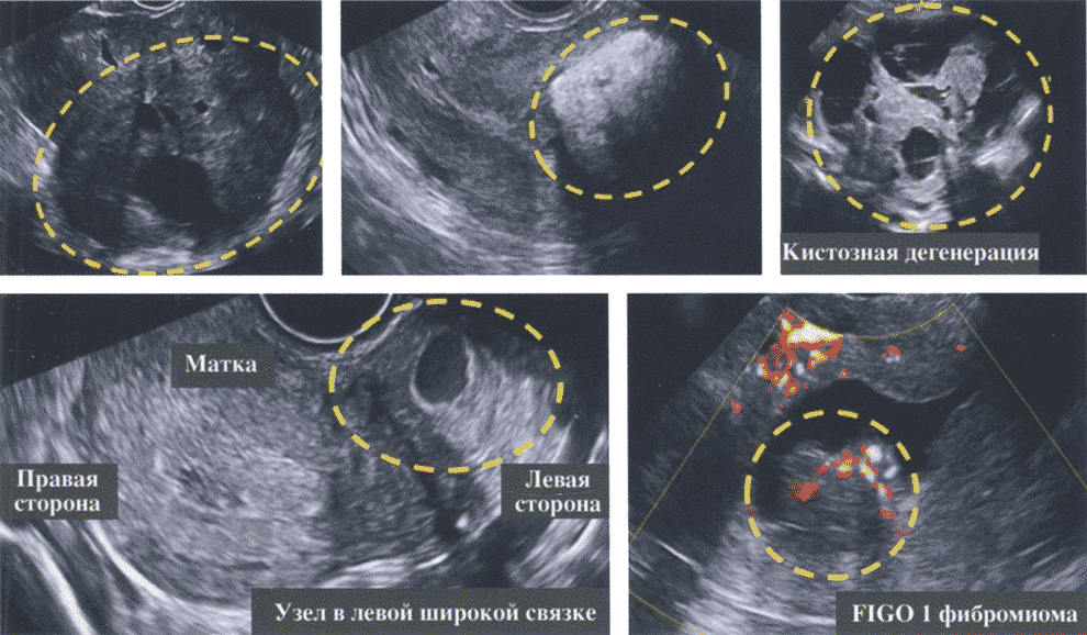  Эхограммы фибромиом матки с атипичными ультразвуковыми проявлениями
