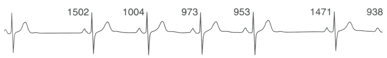  Блокированные предсердные экстрасистолы