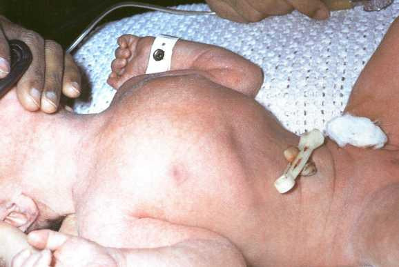Рис. 4. Внешний вид новорожденного с диафрагмальной грыже