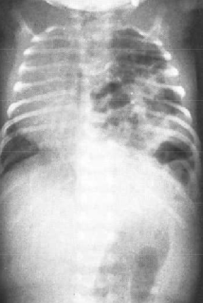 Рис. 6. Рентгенограмма новорожденного с диафрагмальной грыжей