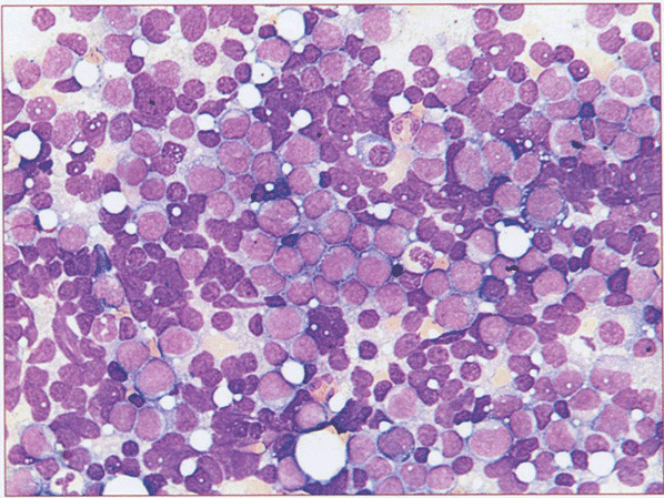  Костный мозг. ОМЛ. Препарат «particle» - тотальная метаплазия костного мозга мономорфной опухолевой популяцией