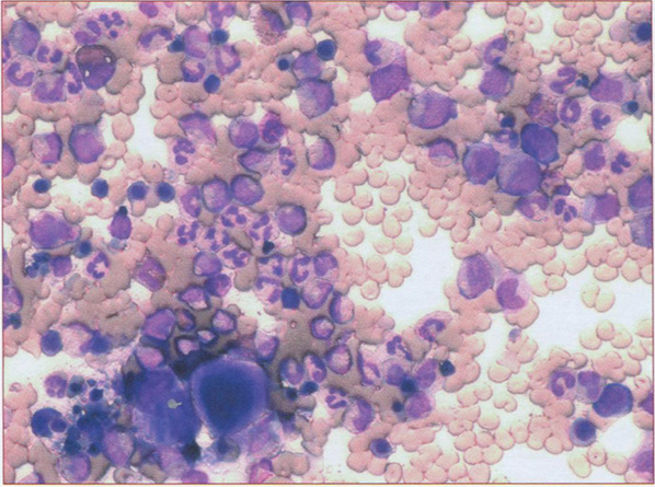 Костный мозг. ХМЛ. Пунктат полиморфный,богат клеточными элементами. х200