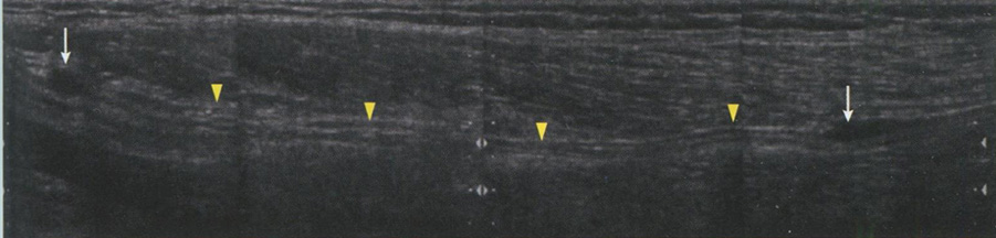 Сонограмма огнестрельного повреждения седалищного нерва в верхней трети бедра