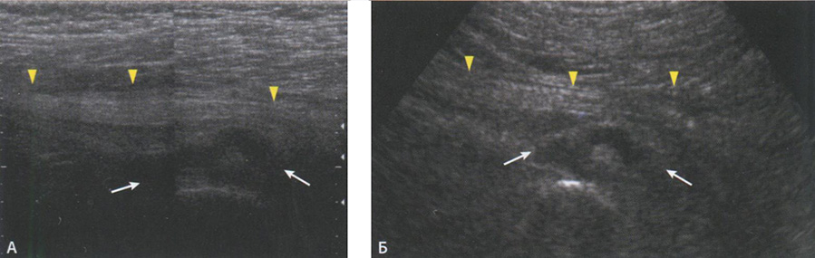Сонограммы сдавления седалищного нерва гематомой на уровне седалищной кости