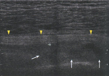 Продольная сонограмма седалищного нерва (головки стрелок), который поддавливает полуорганизовавшаяся гематома (стрелки)