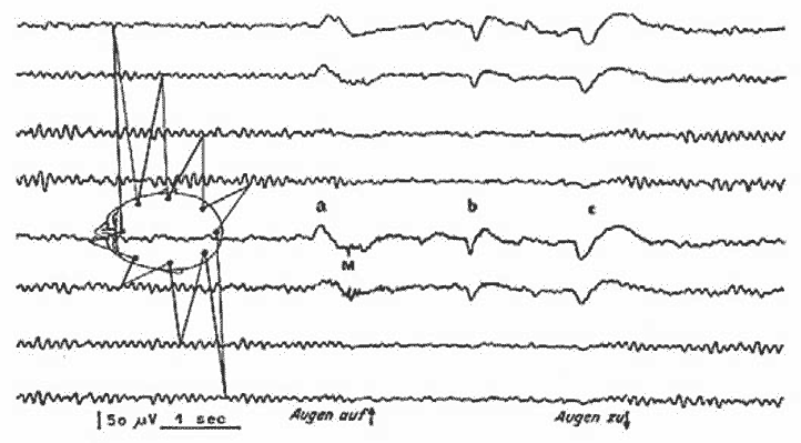 Рис. 334. Нормальная ЭЭГ. Е. Bleuler et al. (1983).