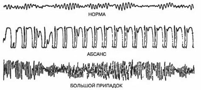  Типичная ЭЭГ при некоторых приступах