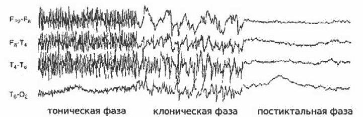 Рис. 340. ЭЭГ при тонико-клоническом припадке.