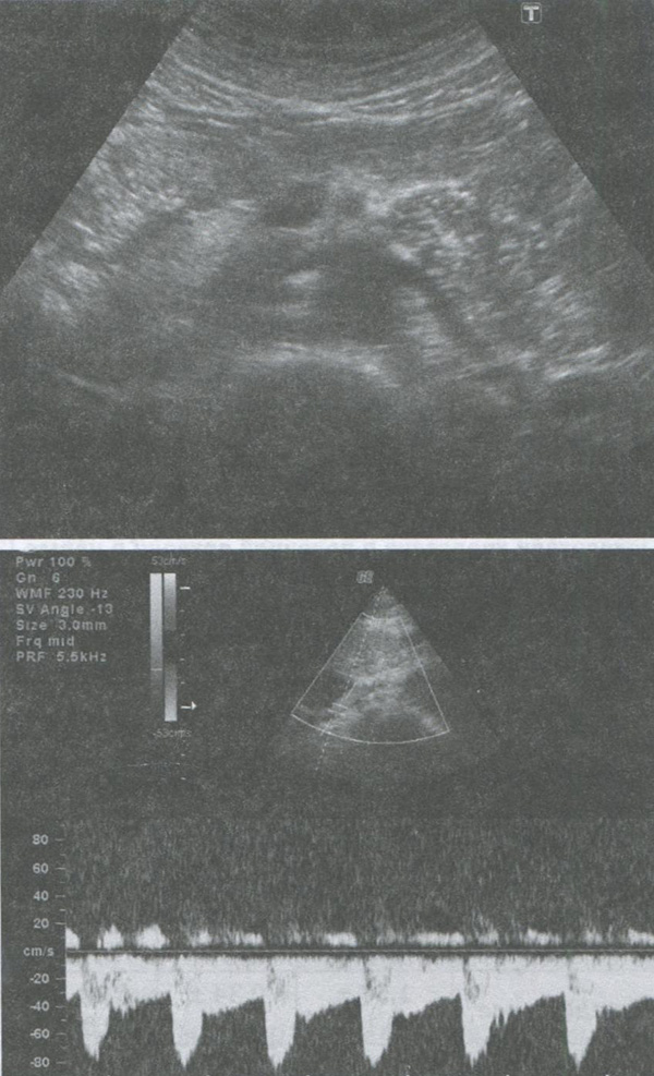 Рисунок 7.2 Брюшной отдел аорты и устья почечных артерий, поперечная плоскость сканирования.