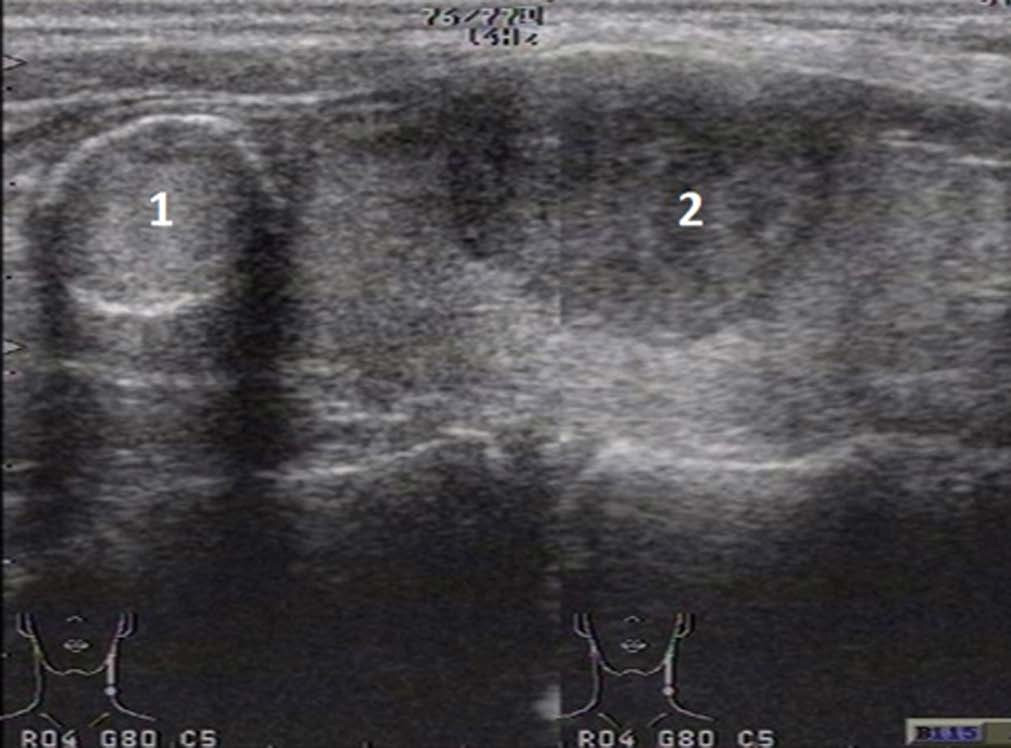 Рисунок 8 – Доброкачественные узлы щитовидной железы: 1 – кальцинированный узел, 2 – аденома
