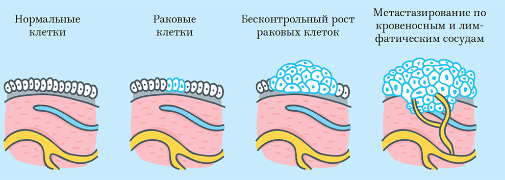 Рост и распространение раковых клеток