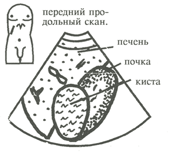 Солитарные кисты почки