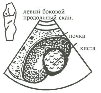 Солитарные кисты почки 2