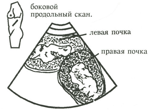 Схема. L-образная почка: обе почки визуализируются слева, левая почка сращена нижним полюсом