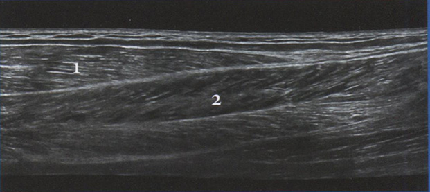 Продольный па­норамный срез задних отделов голени. Икроножная мышца 