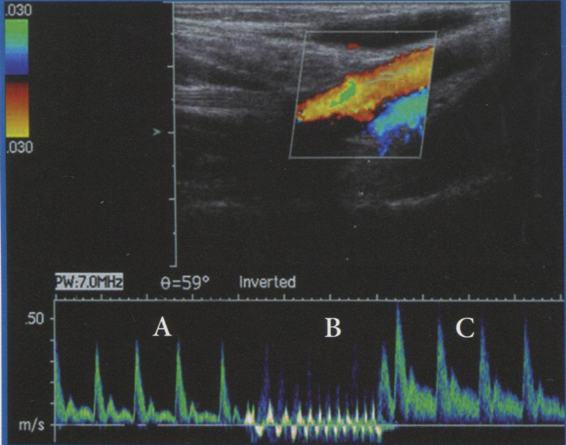 При спектральной доп­плерографии регистриру­ется артериальный кро­воток в мышце с высоким индексом резистентности