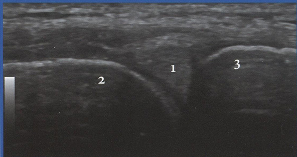 Продольный срез на уровне медиального отдела ко­ленного сустава
