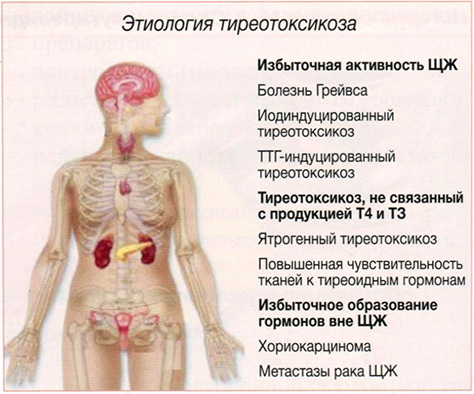 Этиология тиреотоксикоза