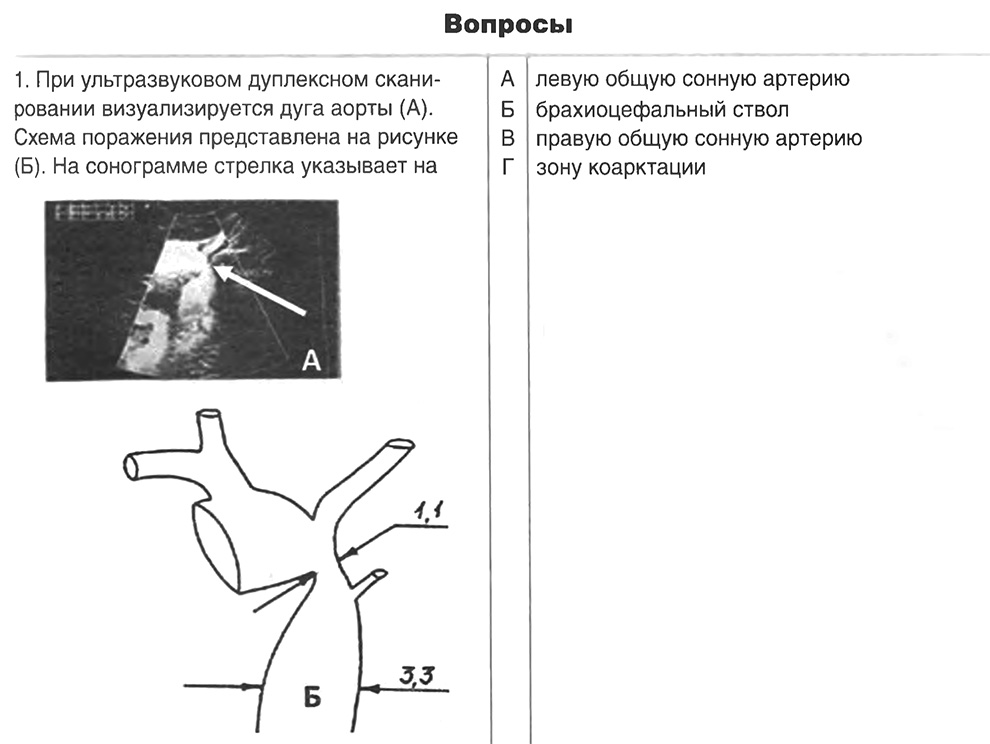 Коарктация аорты