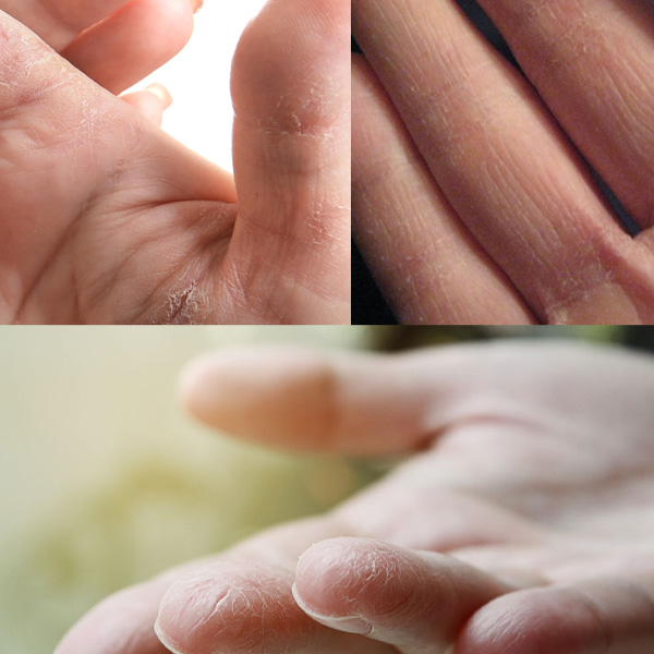 Сухая кожа рук: правила ухода и эффективные методы восстановления