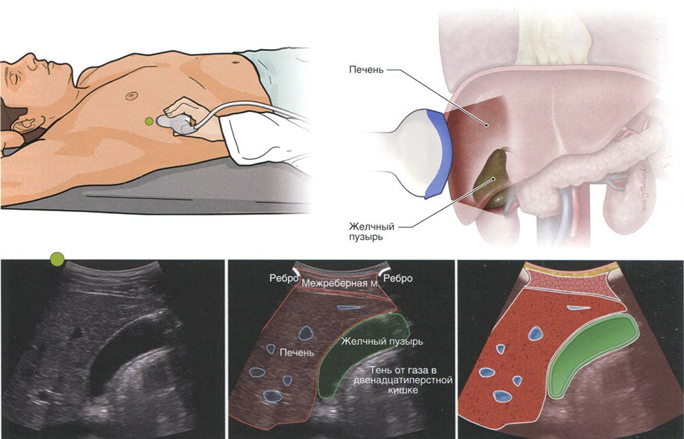 Рис. 8.11. Межреберная продольная проекция желчного пузыря (печеночное акустическое окно)