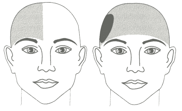 Типичная локализация боли при мигренозных приступах Типичная локализация боли при мигренозных приступах