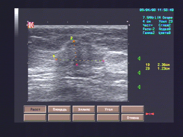 Эхографические признаки новообразования правой молочной железы (исключить рак Педжета)