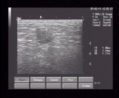 В проекции внутренней поверхности левой ягодицы на глубине 8 мм лоцируется гипоэхогенное образование