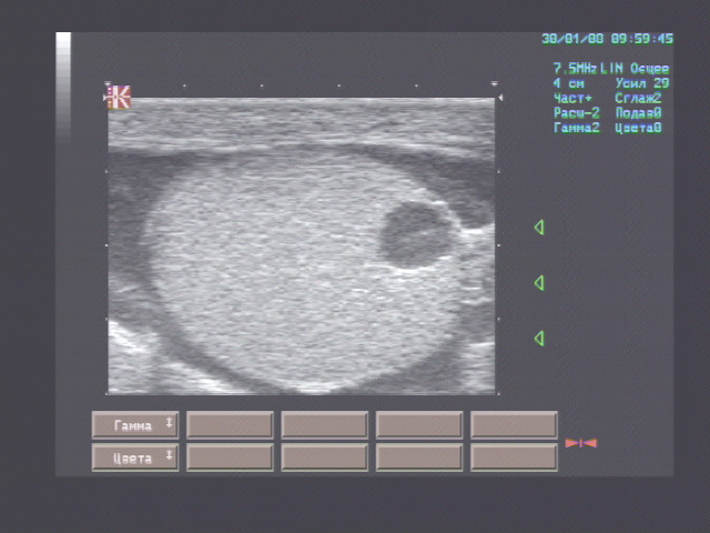 Эхографические признаки кисты правого яичка, правостороннего эпидидимита, множественных кист оболочек левого яичка