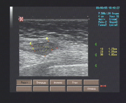 Эхографические признаки новообразований на месте удалённой правой молочной железы (состояние после правосторонней мастэктомии)
