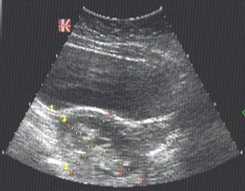 аточная беременность сроком 12,5 – 13 недель. Эхографические признаки кисты жёлтого тела левого яичника